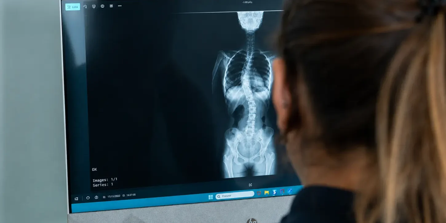 escoliose-em-adultos-avaliacao-especializada-coluna Fisioterapeuta a analisar radiografia de adulto com escoliose durante avaliação especializada da coluna